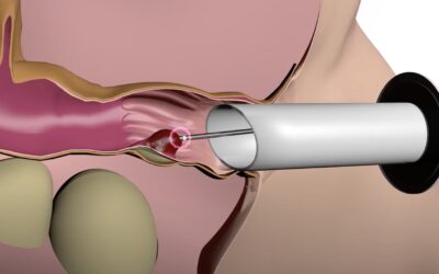 Η χρήση των ραδιοσυχνοτήτων (Μέθοδος Rafaelo®) στην αντιμετώπιση της αιμορροϊδοπάθειας