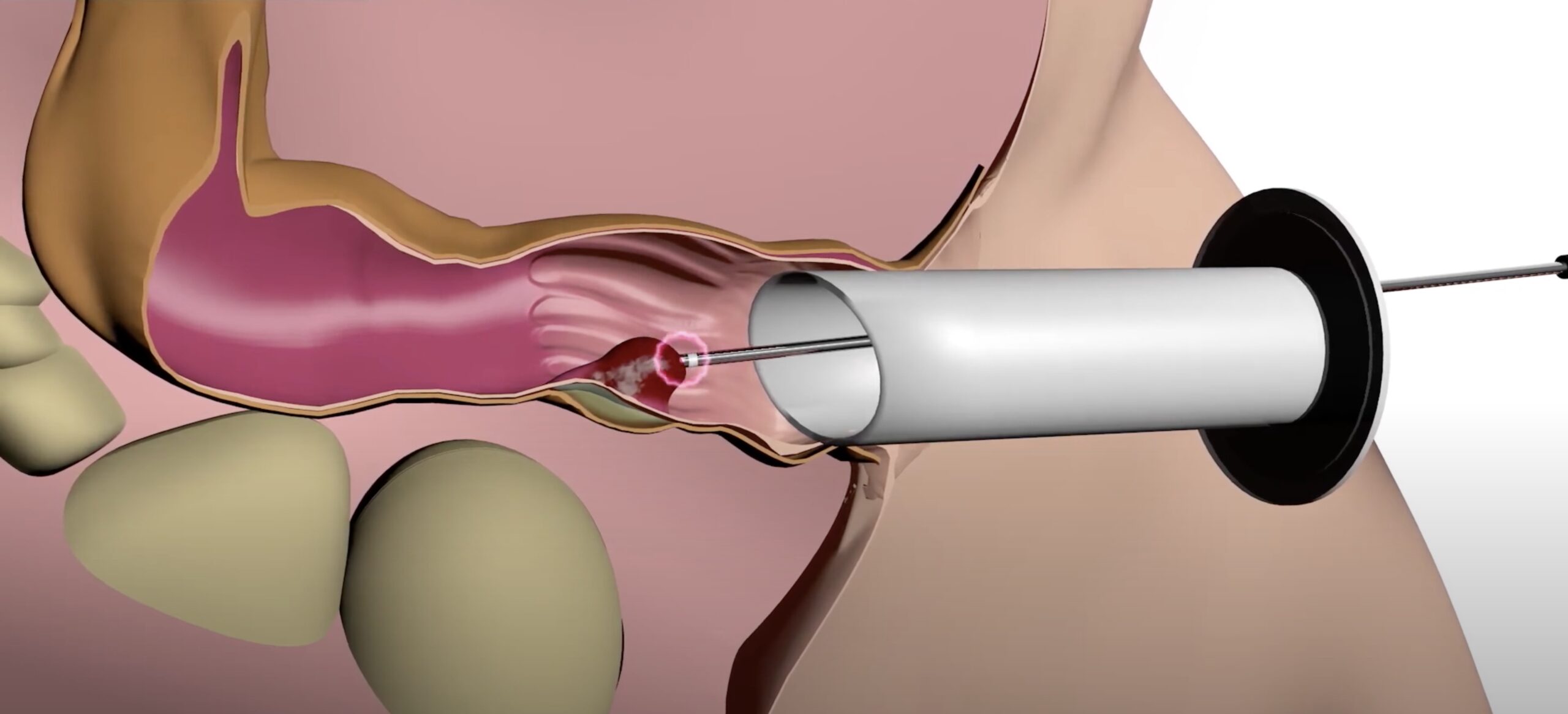 ablation-of-haemorrhoids